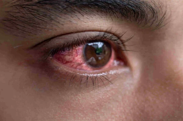 Healthy food for eyes flu